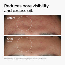 The Ordinary Niacinamide 10% + Zinc 1%, Smoothing Serum for Blemish-Prone Skin — Complimentary Gift with $24+ Orders; If the Gift Is Out of Stock or Its Price Rises, Order Cancelled with Full Refund Before Shipment